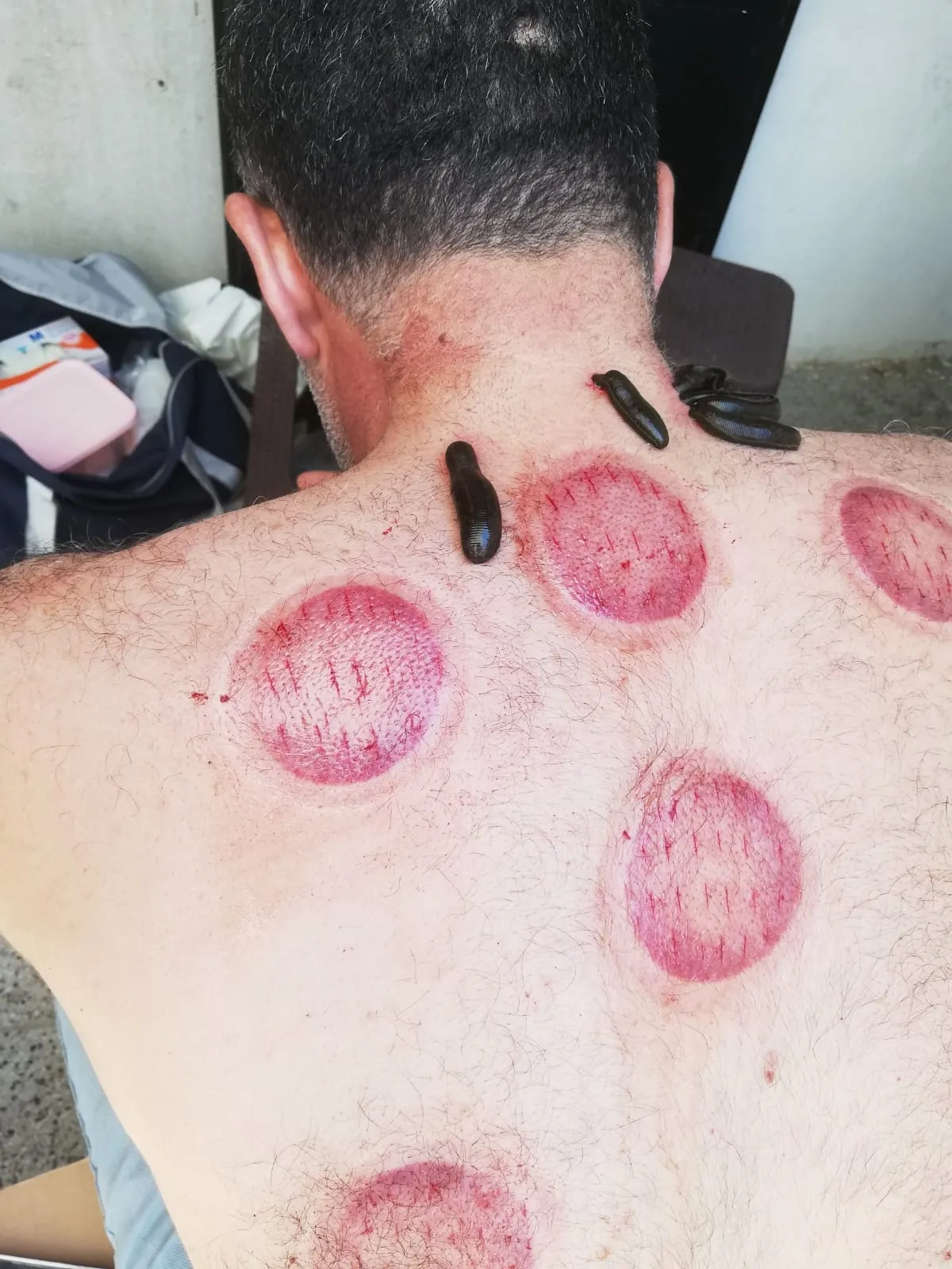   Hacamat ve Sülük Tedavisinin Faydaları: Aydın, Söke ve Kuşadası'nda Doğal Şifa Yöntemleri